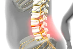 Herniated Disk: Symptoms and Diagnosis
